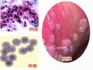 卵巢囊肿
